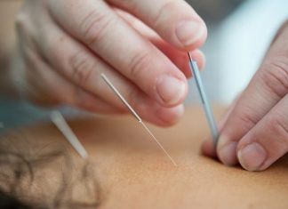 Caucasian hands putting acupuncture needles into person's back